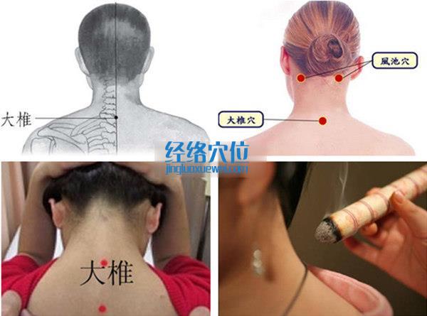 大椎穴的準確位置圖（高清圖組）