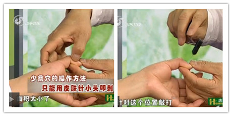 少商穴的操作方法只能用皮膚針小頭叩刺，因為它面積太小了，敲打出血來