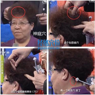 王教授現場演示，針灸穴位止頭痛